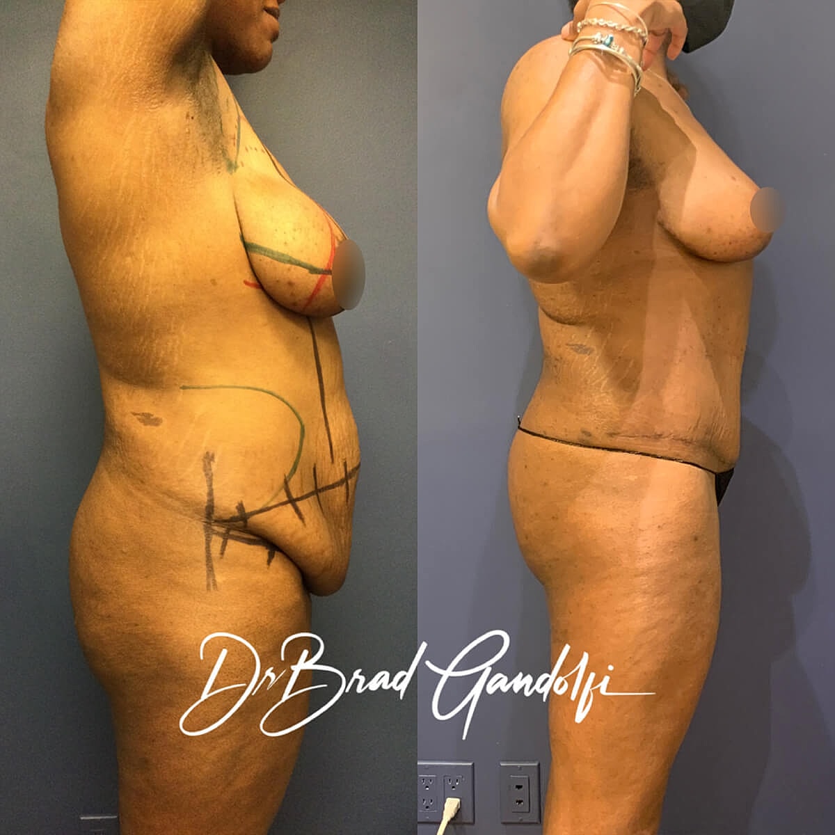 Mommy Makeover Before & After