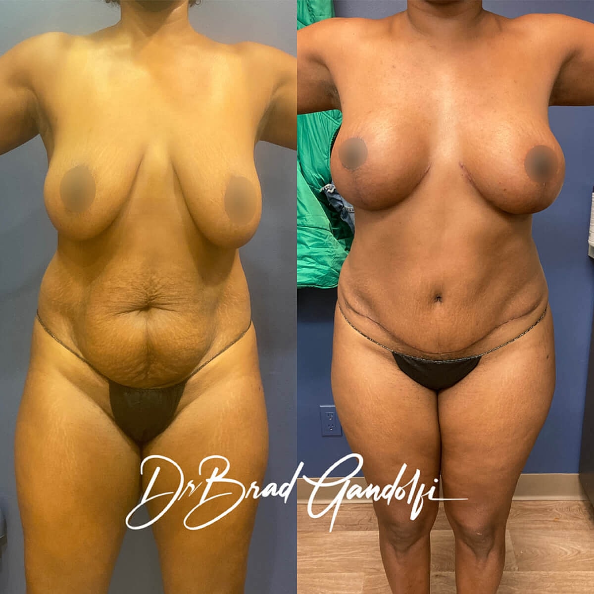 Mommy Makeover Before & After
