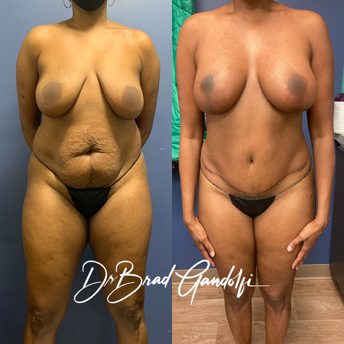 Mommy Makeover Before & After