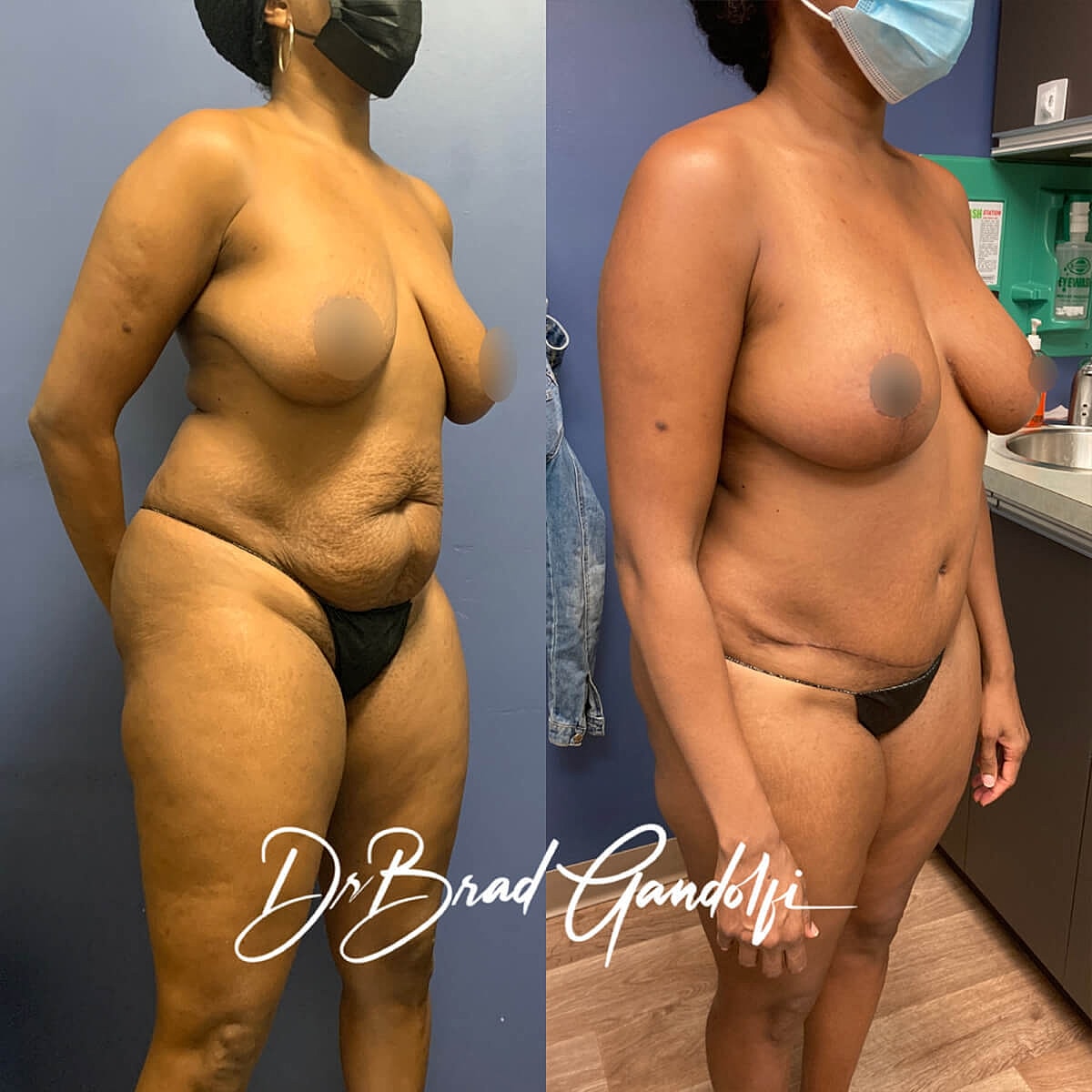 Mommy Makeover Before & After