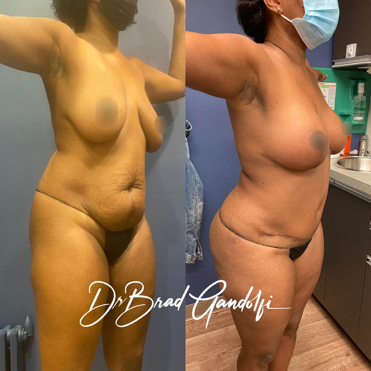 Mommy Makeover Before & After