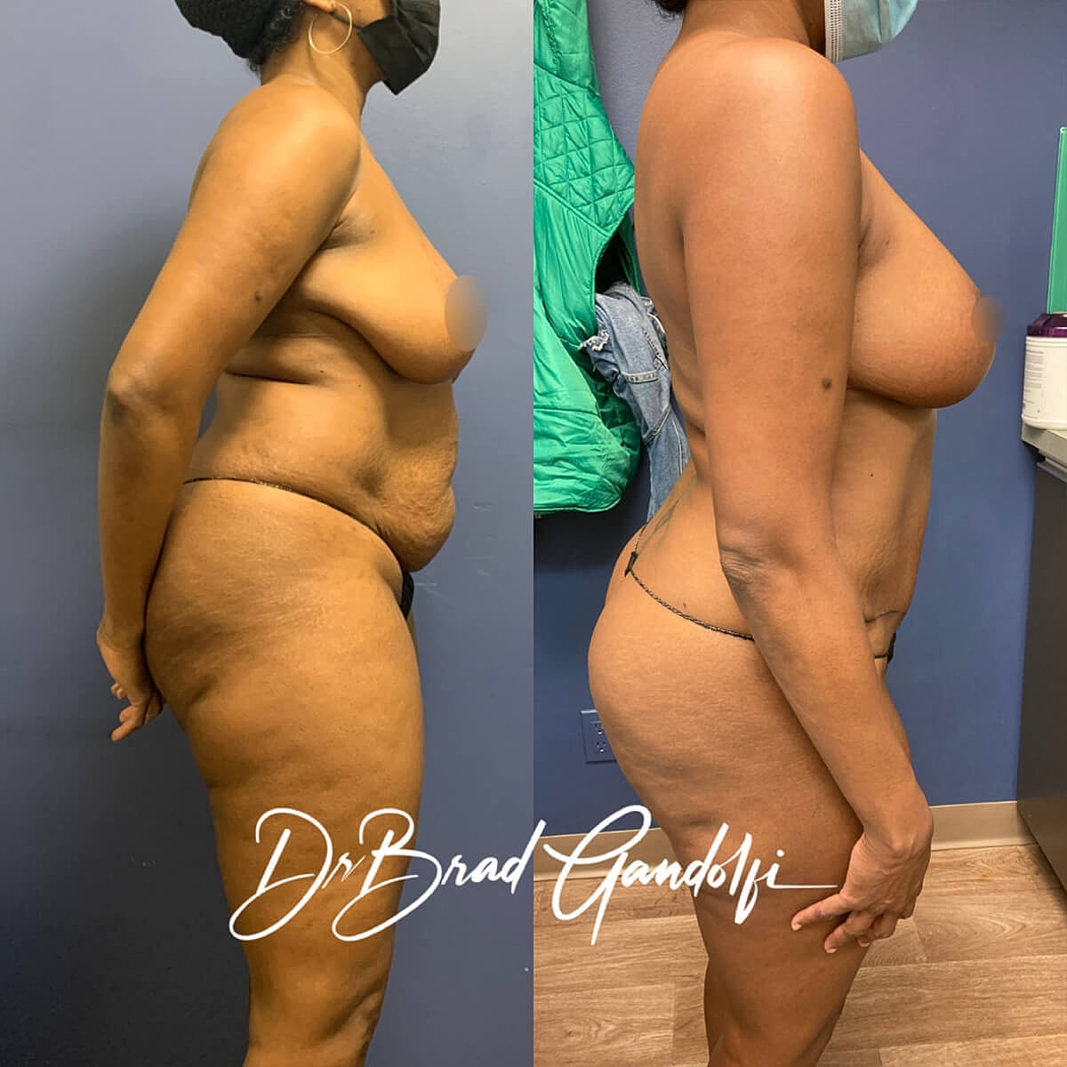 Mommy Makeover Before & After