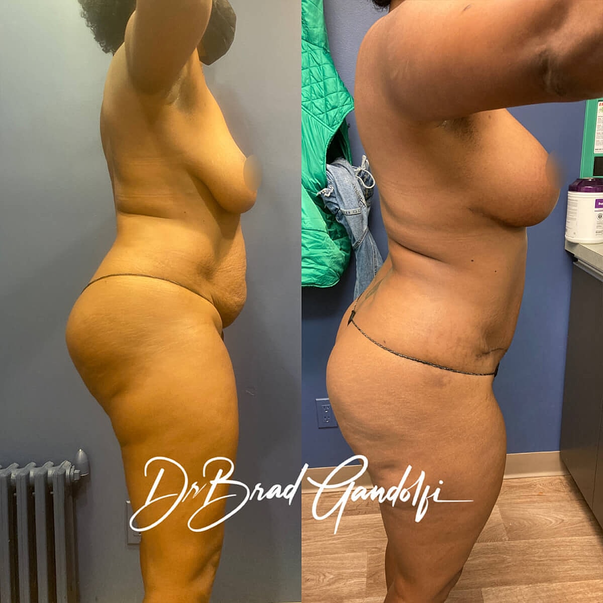 Mommy Makeover Before & After