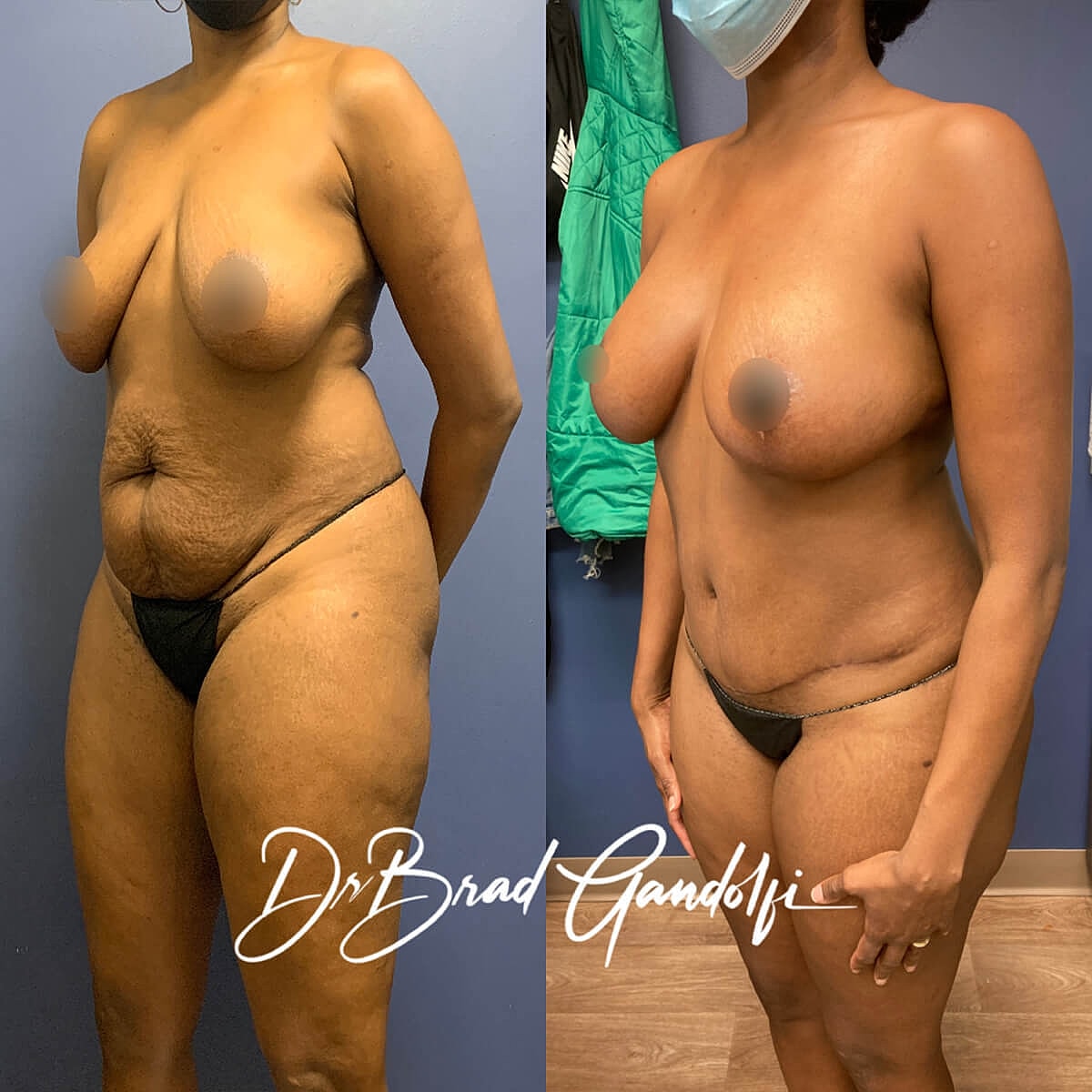 Mommy Makeover Before & After