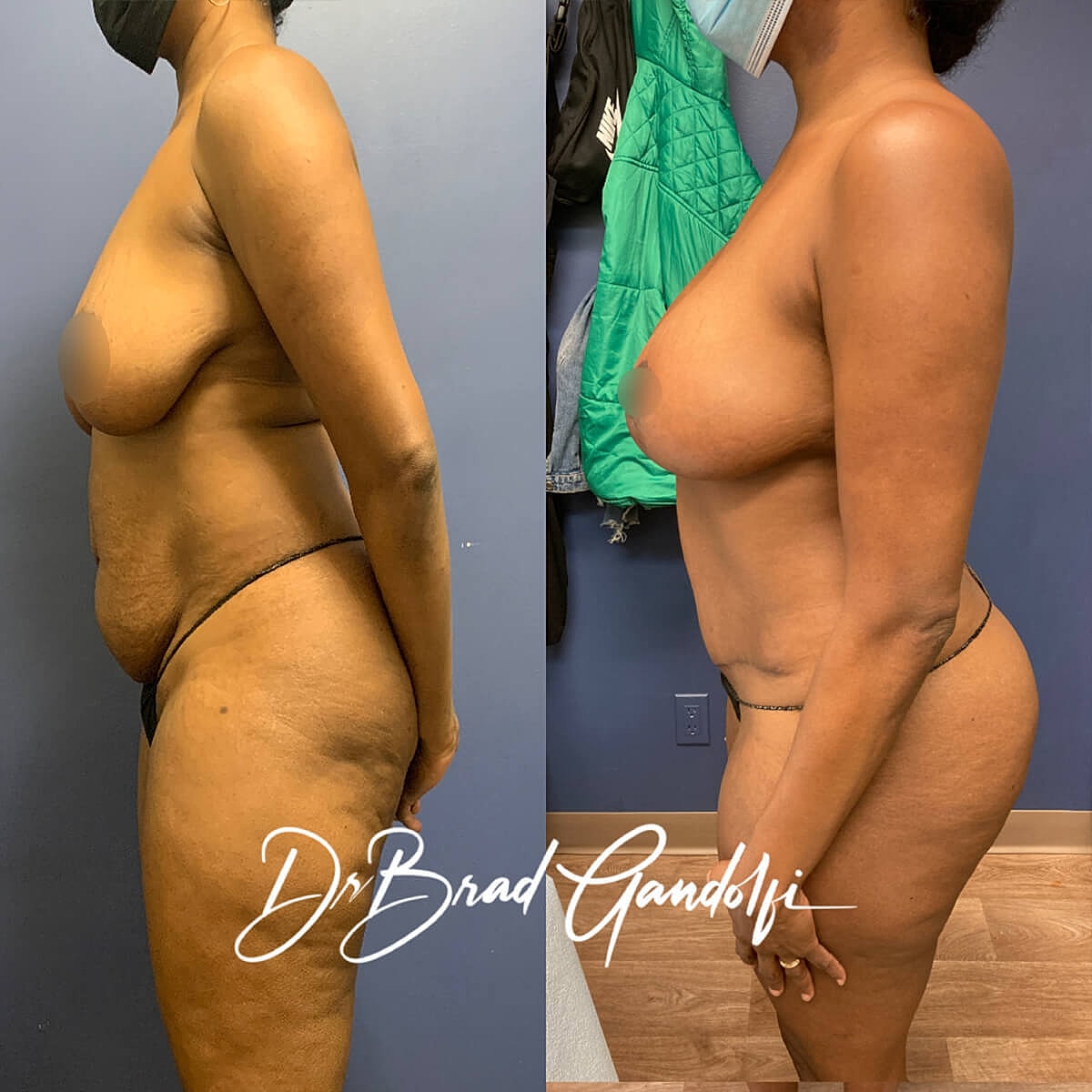 Mommy Makeover Before & After
