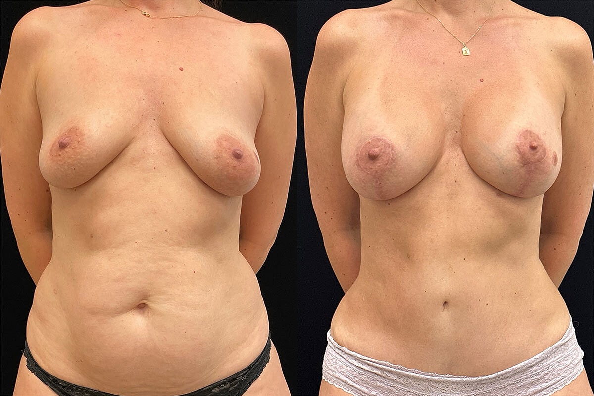 Mommy Makeover Before & After